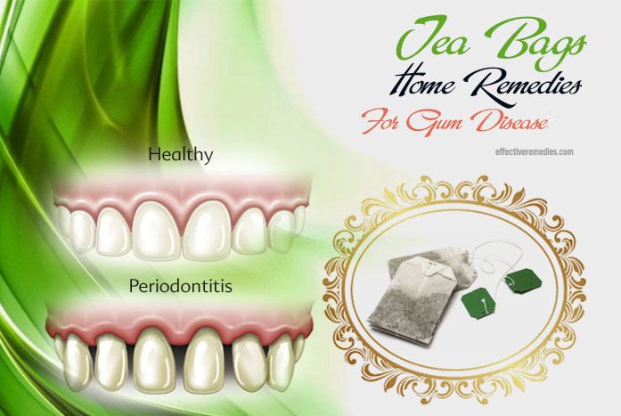 12 Common Home Remedies For Gum Disease That Work Naturally