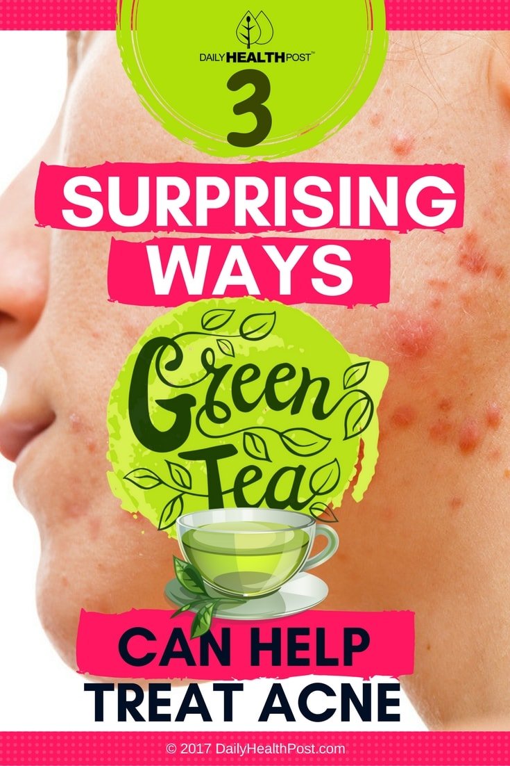 3 Surprising Ways Green Tea Can Help Treat Acne