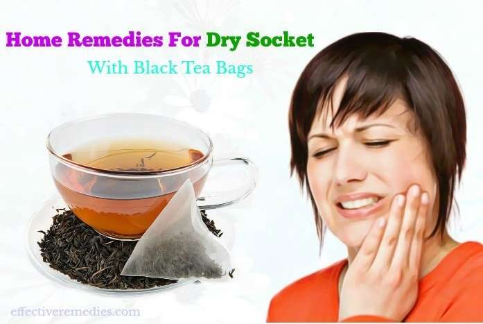 9 Best Natural Home Remedies For Dry Socket Pain &  Other ...