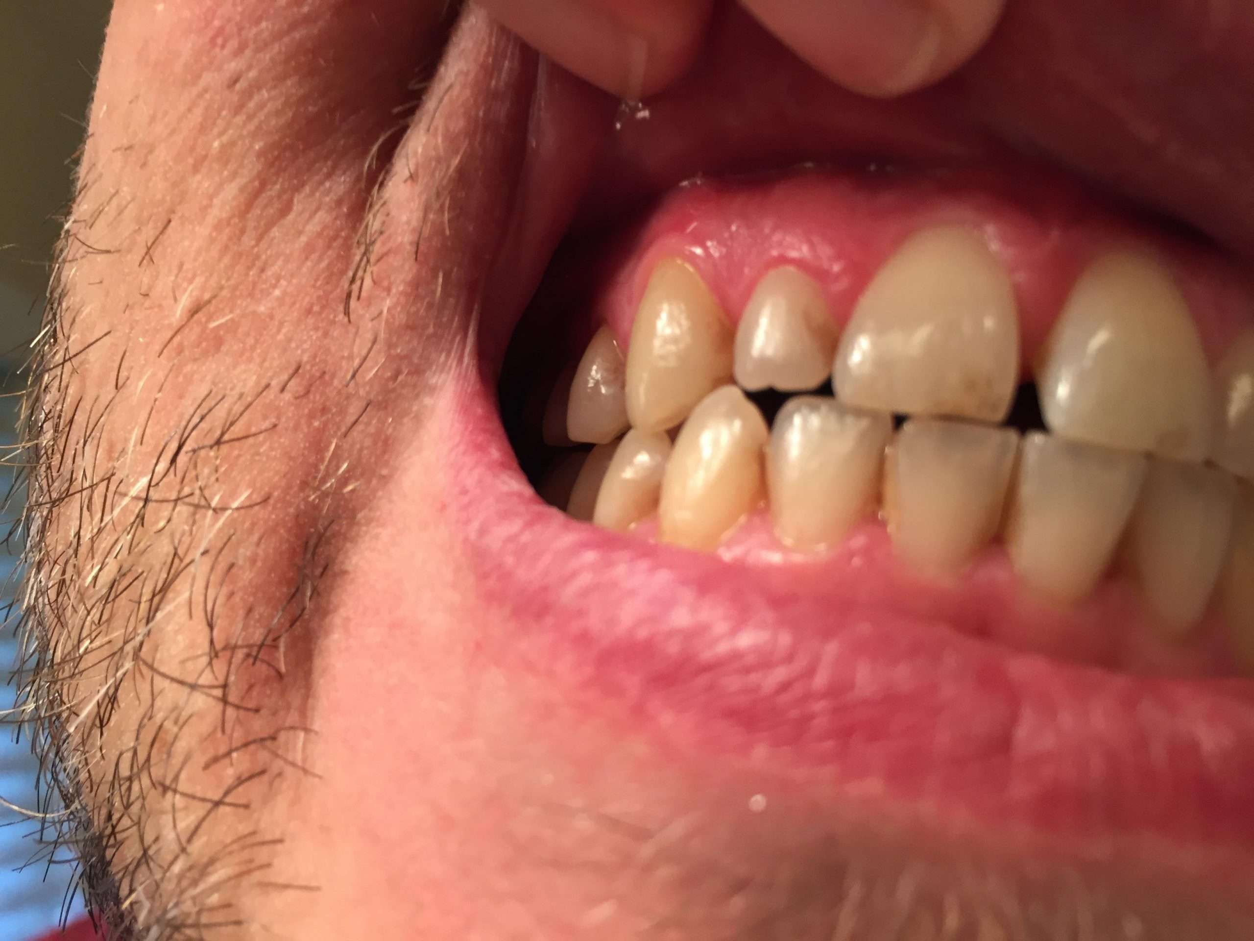 Brown stains recently appeared on the sides of my teeth and near my ...
