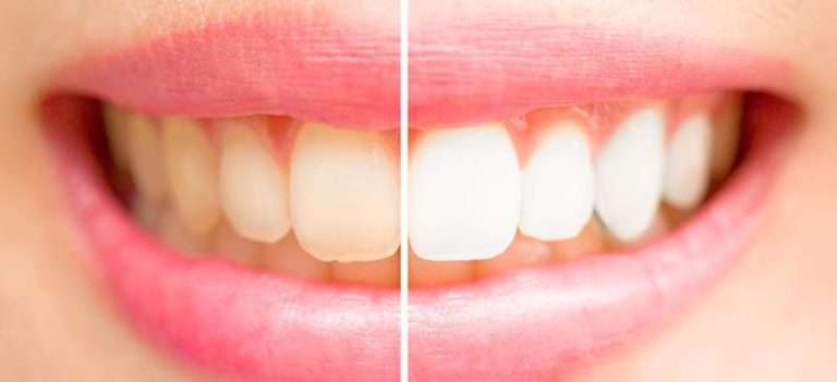 Tea and Coffee Teeth Stains: How To Remove Them