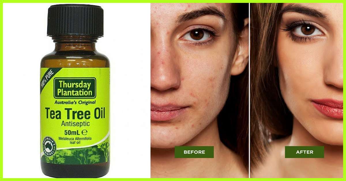 Tea Tree Oil For Acne  Benefits, Uses, Risks, And More