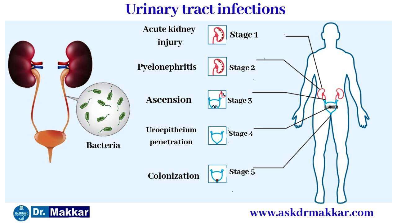 Urinary tract infection UTI Treatment using homeopathy ...