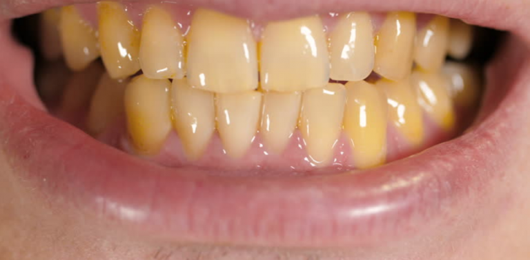 What Causes Yellow Teeth?